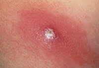 Boils may recur in those with conditions in which resistance to bacterial infection is impaired.