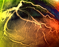 Coronary angiogram shows degrees of arterial stenosis