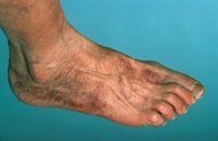 Thrombolysis and surgery were equally effective for treating limb ischemia