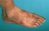 Limb ischemia: Thrombolysis may increase risk of major complications compared with surgery