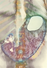 A peptic ulcer (white) is formed when stomach acid and bacteria irritate the lining of the stomach.
