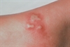 Similar-appearing vesicles
