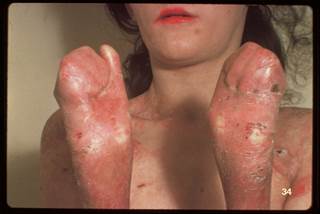 Skin fusion on the fingers and toes of an adolescent girl Skin fusion on the fingers and toes of an adolescent girl