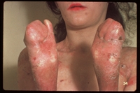 Skin fusion on the fingers and toes of an adolescent girl