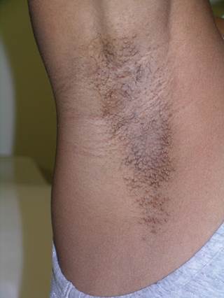 Bilateral pruritic papules on a woman's axillae Bilateral pruritic papules on a woman's axillae