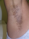 Bilateral pruritic papules on a woman's axillae