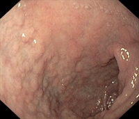 In celiac disease, the lining of the intestine reacts to gluten