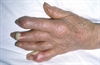 Gout