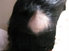 Hair loss in discrete areas