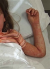Severe pruritic rash, fever, and malaise