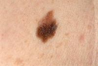Generally larger with irregular borders, dysplastic nevi are acquired melanocytic skin lesions.