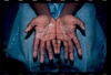 Enlarging vesicular peeling of the palms