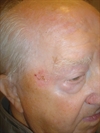 Facial plaques in aging men