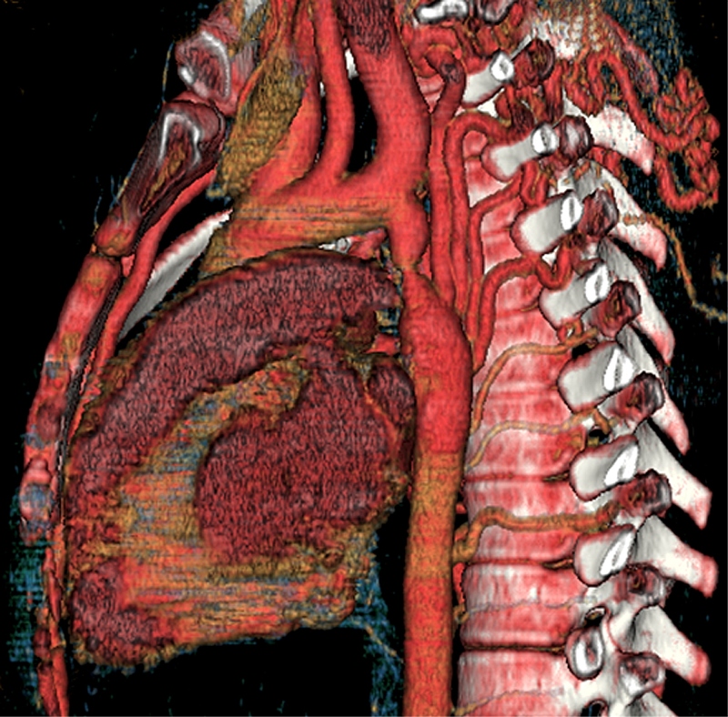 Diagnosing coarctation of the aorta - The Clinical Advisor