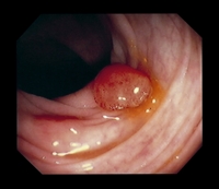 Colonic polyps may cause discomfort and obstruct the passage of food.
