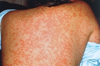 Measles (shown) can be prevented by a combination vaccine.