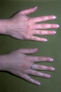 Argyria is an irreversible condition caused by silver accumulation in the skin.