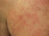 A pair of generalized red rashes