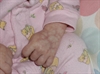 Irregular purplish blue markings on the limbs of a newborn