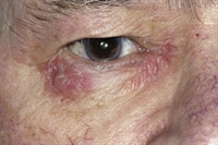 Atopic dermatitis (eczema) may result from allergic reaction to some materials or drugs.