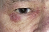 Recurrent periorbital dermatitis
