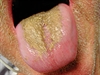 Offensive odor emanating from tongue plaque