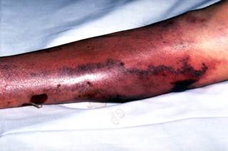 Clinical signs of reduced blood flow may be an indication of peripheral arterial disease. Clinical signs of reduced blood flow may be an indication of peripheral arterial disease.