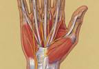 Carpal tunnel syndrome Carpal tunnel syndrome
