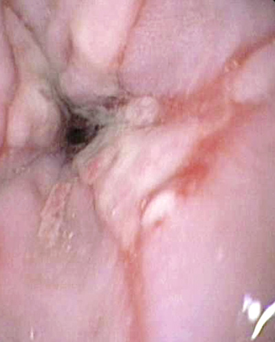 Indigestion Lump In Throat 4