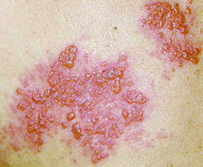 Herpes simplex - Wikipedia