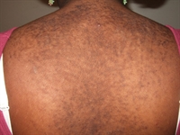 Brown bumps that evolved into verrucous plaques