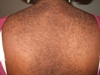 Brown bumps that evolved into verrucous plaques
