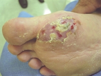 Nonhealing painless ulcer on the sole 