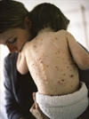 Herpes zoster risk in an infant