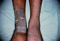 Persistent plaque with severe intermittent pruritus