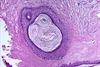 Treatment of vulvar lichen sclerosus