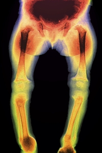 Rickets (shown) is a bone disorder caused by a lack of vitamin D.