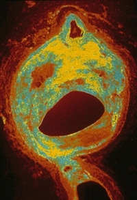 Arterial plaque (yellow and blue) may cause clot formation.