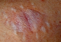 Most brown recluse spider bites result in mild swelling and erythema.