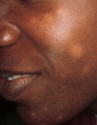 White areas on the face of a teenager
