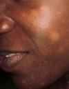 White areas on the face of a teenager
