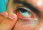 Cutaneous symptoms uncover unintentionally obscured disease Cutaneous symptoms uncover unintentionally obscured disease
