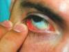 Cutaneous symptoms reveal an unintentionally obscured disease