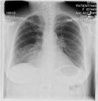 An infrequent cause of chronic cough