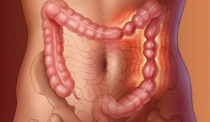 Irritable bowel syndrome made simple