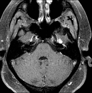 Abnormal, confluent enhancement of the left facial nerve in a patient with Bell’s palsy Abnormal, confluent enhancement of the left facial nerve in a patient with Bell’s palsy