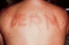 Pressure-induced bumps and erythema