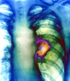 When to suspect lung cancer, and what to do