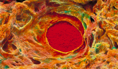 Mixing NSAIDs with antiplatelet therapy