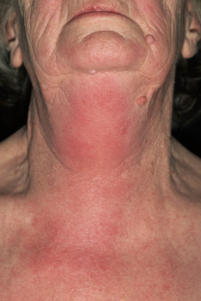 What are some symptoms of angioedema?